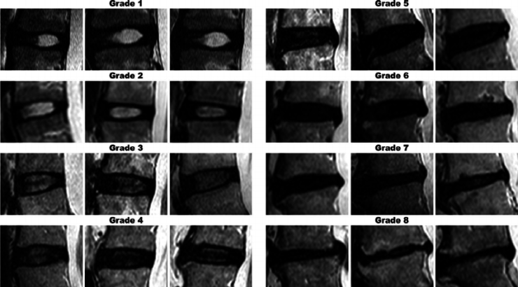 IMAGE 1 Image-reference-panel-shows-increasing-severity-of-disc-degeneration-The-pertinent